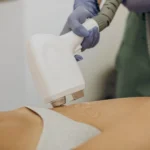 لیزر موهای زائد بیکینی