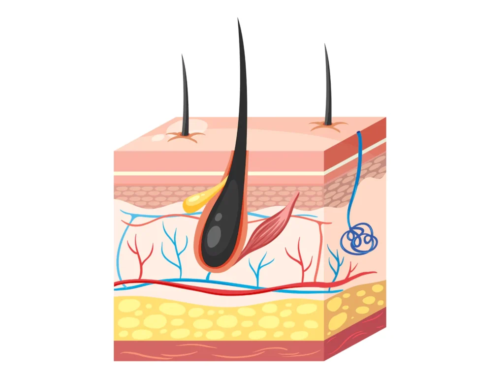 سوزاندن ریشه مو با لیزر
