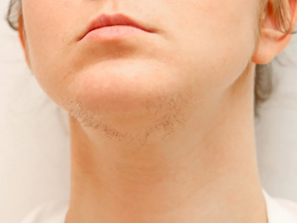 موهای زائد چانه و علل آن